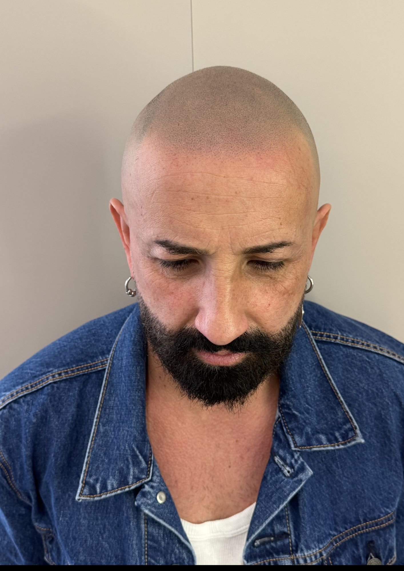 Risultato tricopigmentazione Mazzola Napoli